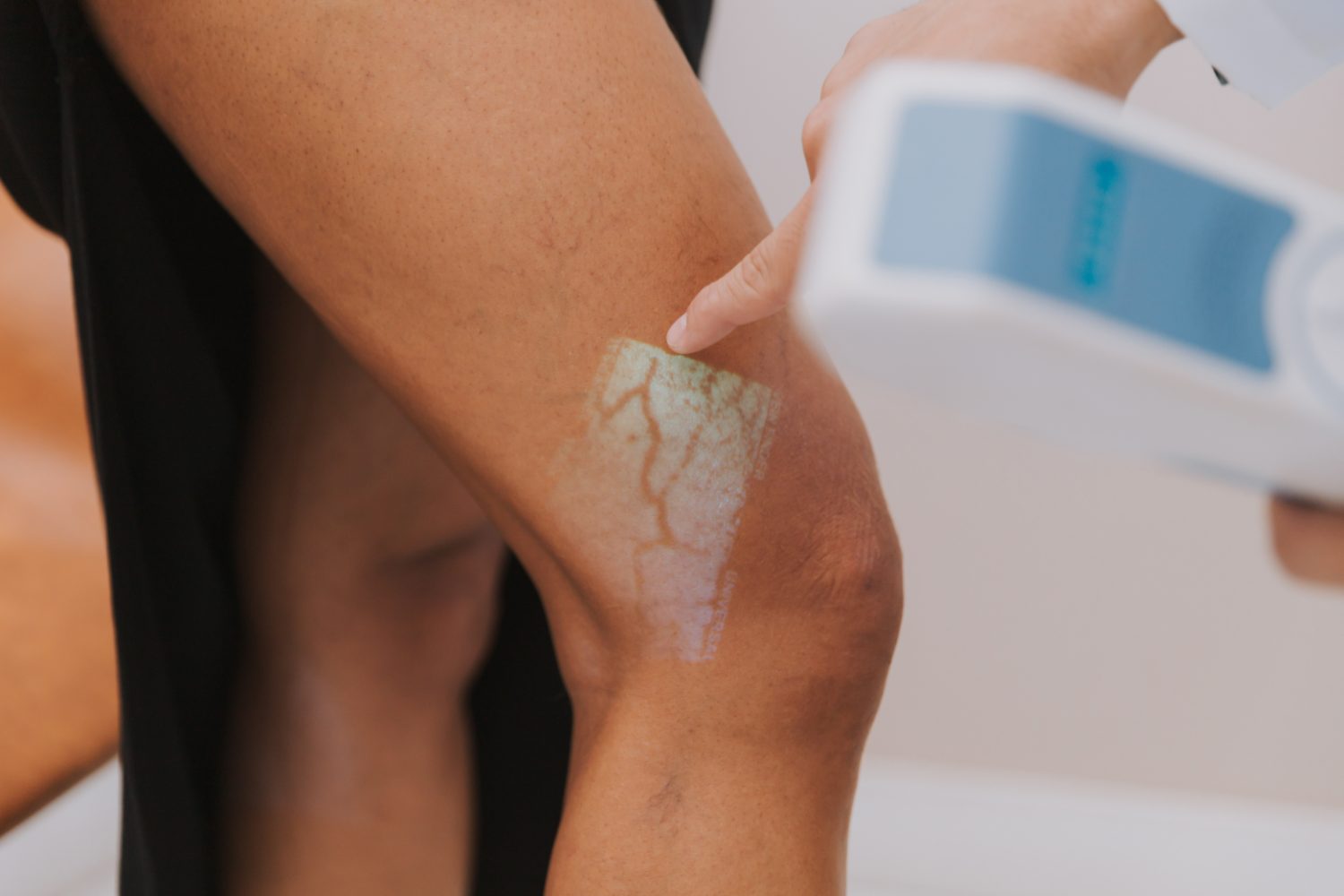 Mapeamento das veias com transiluminação durante a avaliação